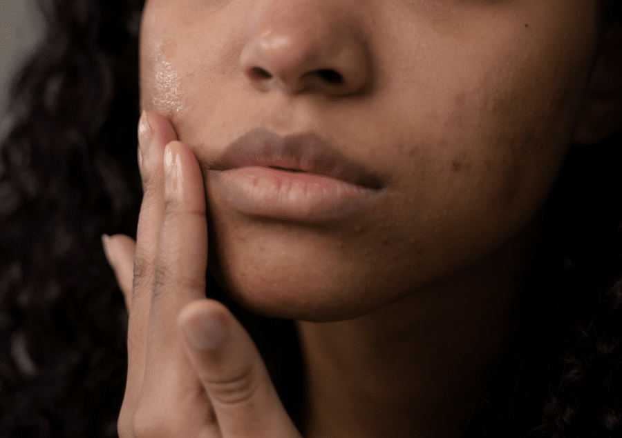 acne hormonale quelles solutions