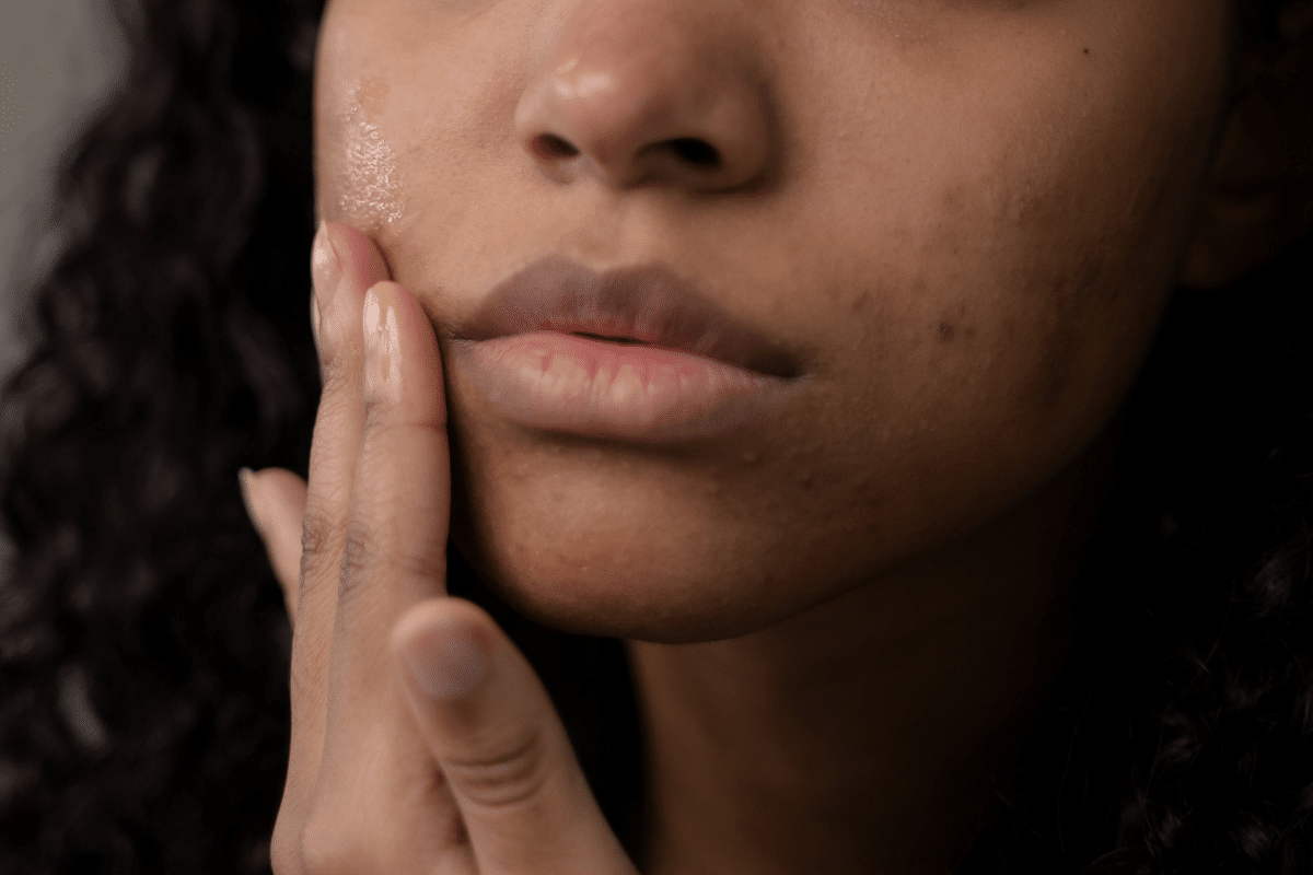 acne hormonale quelles solutions