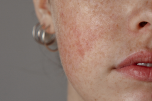 Rosacée Causes et Solutions Naturelles