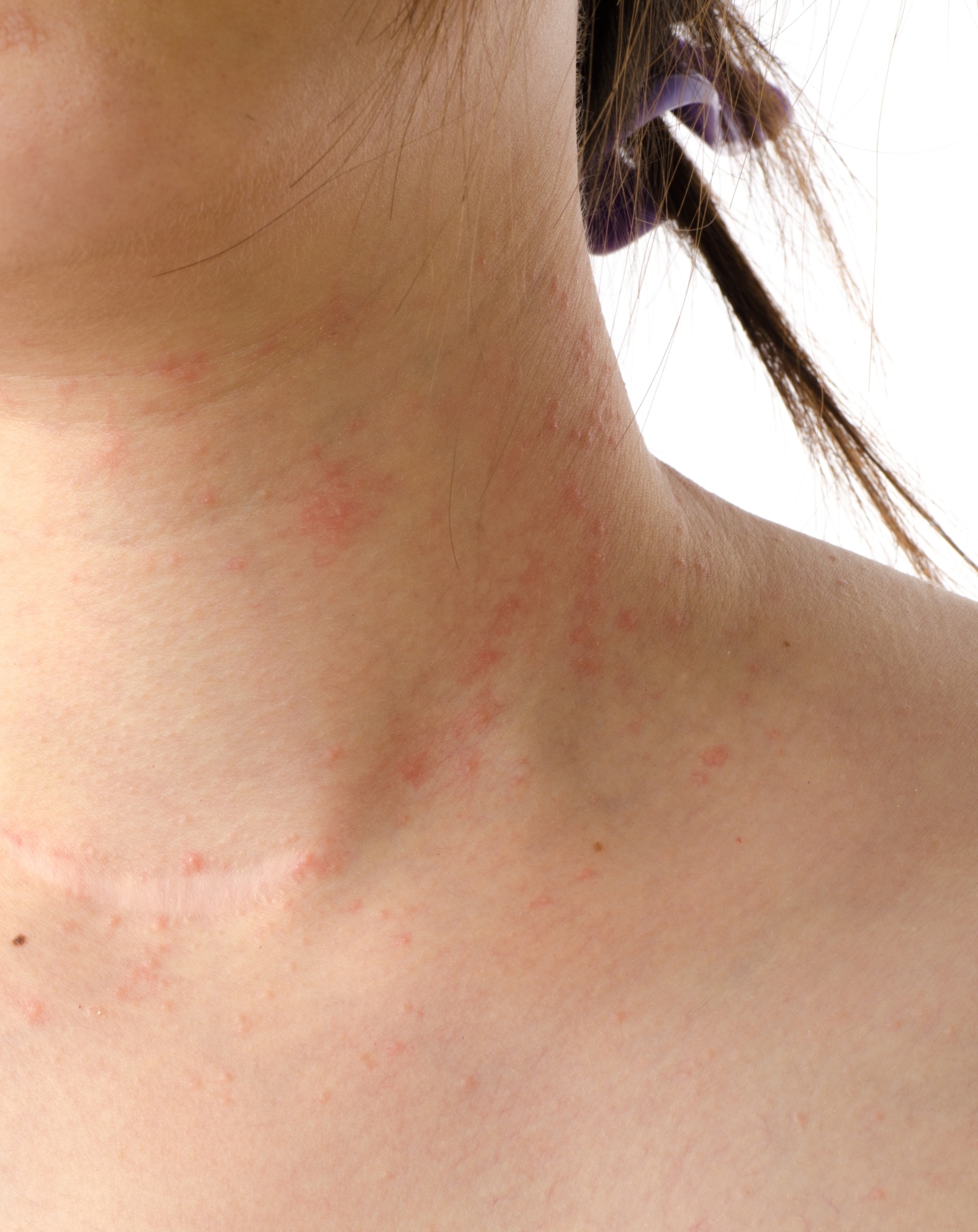 eczéma
